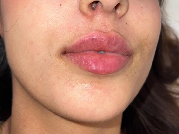 Labbra dopo il filler, caso 5