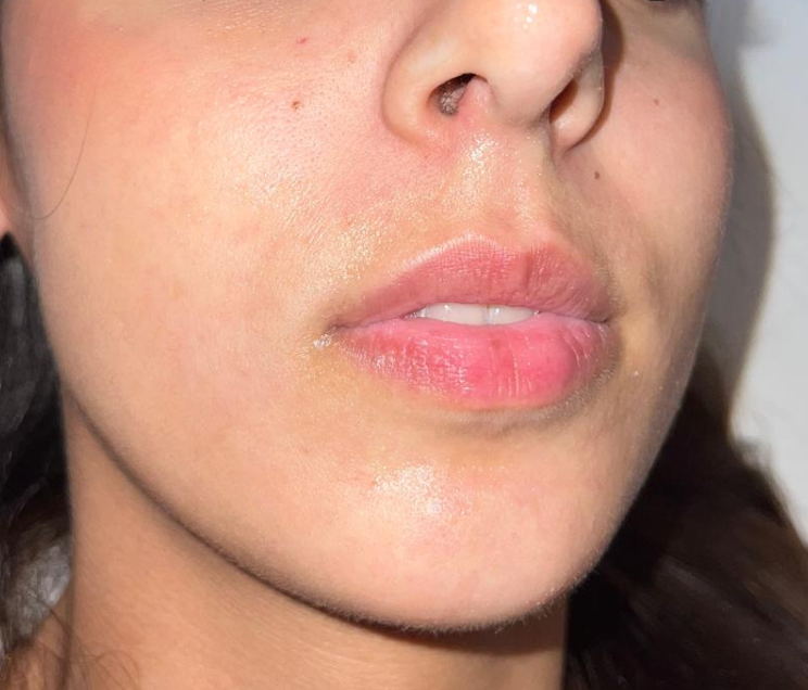 Labbra prima del filler, caso 5
